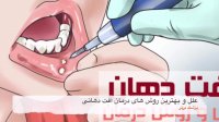 علل ایجاد آفت دهانی و بهترین روش های درمان آن
