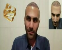 کاشت مو- کلینیک رنسانس