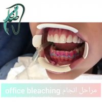 مراحل بلیچینگ دندان
