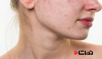 انواع آکنه و روش‌های درمانی آن