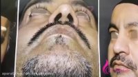 بلافاصله بعداز جراحی بینی در اتاق عمل