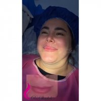 حجم دهی دائمی لب بالا