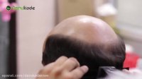 ریزش مو در مردان ( قسمت اول )