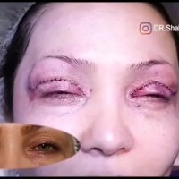 جراحجراحی بلفاروپلاستی پلک بالای بلفاروپلاستی پلک بالا