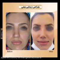 نمونه کارهای جراحی بینی دکتر رزم آرا