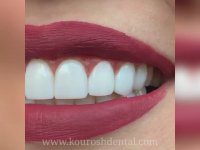 طراحی لبخند زیبا با ونیر کامپوزیت دندان | کلینیک دندانپزشکی کوروش مشهد