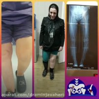 فحص المریضه بعد شهر من عملیه الرکبه المقوسه