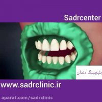 بلیچینگ دندان