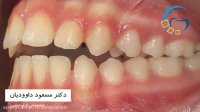 قبل و بعد ارتودنسی اپن بایت | دکتر مسعود داوودیان