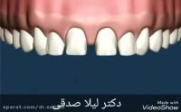 پر کردن فاصله بین دندان