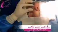 فیلم عمل جراحی زیبایی بینی (قسمت دوم)