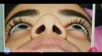 فیلم اصلاح پهنای بینی