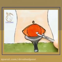 انیمیشن زایمان سزارین