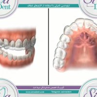 ارتودنسی نامرئی با الاینرهای شفاف | دندانپزشکی سیمادنت