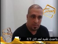 کاشت مو به روش انحصاری sutدر کلینیک تخصصی رنسانس