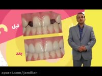 فاصله بین دندان ها و بستن این فاصله با ارتودنسی