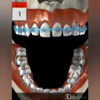 فیلم ازبین بردن فاصله دندان ها با ارتودنسی