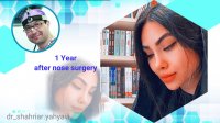 یکسال بعد از جراحی بینی توسط دکتر شهریار یحیوی