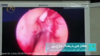 فیلم جراحی خارج کردن پولیپ بینی
