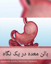 بالون معده در یک نگاه