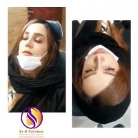 یک هفته بعد از عمل بینی