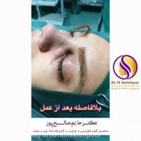 نمونه ای از عمل بینی