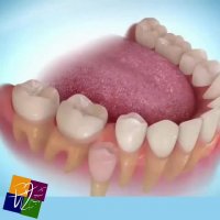 کشیدن زودهنگام دندان های شیری