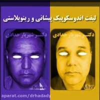 لیفت اندوسکوپیک پیشانی و رینوپلاستی