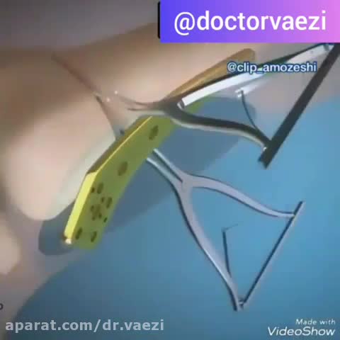 عمل اصلاح انحراف زانو
