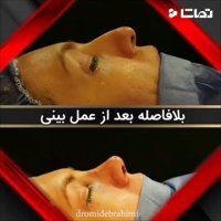 فیلم نمونه کار عمل بینی