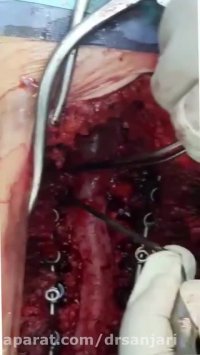 درمان اسکولیوزیس دژنراتیو و تنگی کانال کمری