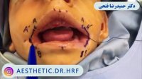 درمان شکاف لب توسط دکتر حمید رضا فتحی