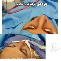 جراحی بینی ترمیمی بلافاصله بعد از عمل