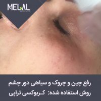 رفع چین و چروک و سیاهی دور چشم