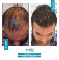 جشنواره پاییزی 77 روزه کاشت مو ایران نوین