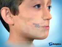 دکتر مسعود داودیان :: درمان ارتودنسی جلو بودن فک پایین با فیس ماسک