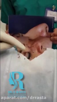 فیلم واقعی جراحی پلک همراه با جراحی زیبایی بینی