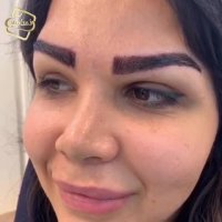 فیلم کاشت ابرو -کلینیک تخصصی رنسانس