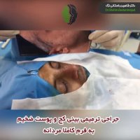 فیلم جراحی ترمیمی بینی کج