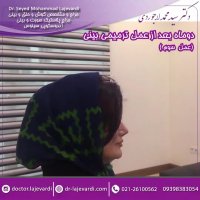 دو ماه بعد از عمل ترمیم بینی توسط دکتر لاجوردی