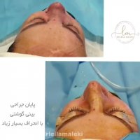 جراحی بینی گوشتی با انحراف شدید