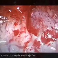 علاج مریض مصاب بالطلقه تحت الحنک و الجبین