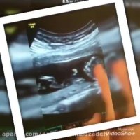 سونوگرافی NT