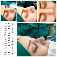 فیلم جراحی بینی گوشتی