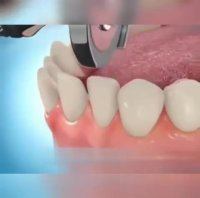 نحوه مرتب سازی دندان توسط ارتودنسی