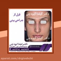 قبل و بعد از عمل جراحی زیبایی بینی