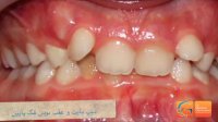 قبل و بعد ارتودنسی دیپ بایت | دکتر مسعود داودیان