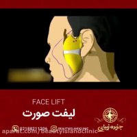 لیفت صورت به روایت تصویر