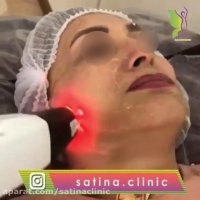 ویدئو واقعی جوانسازی با دستگاه RF