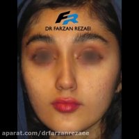 جراحی بینی نیمه فانتزی به روش بسته